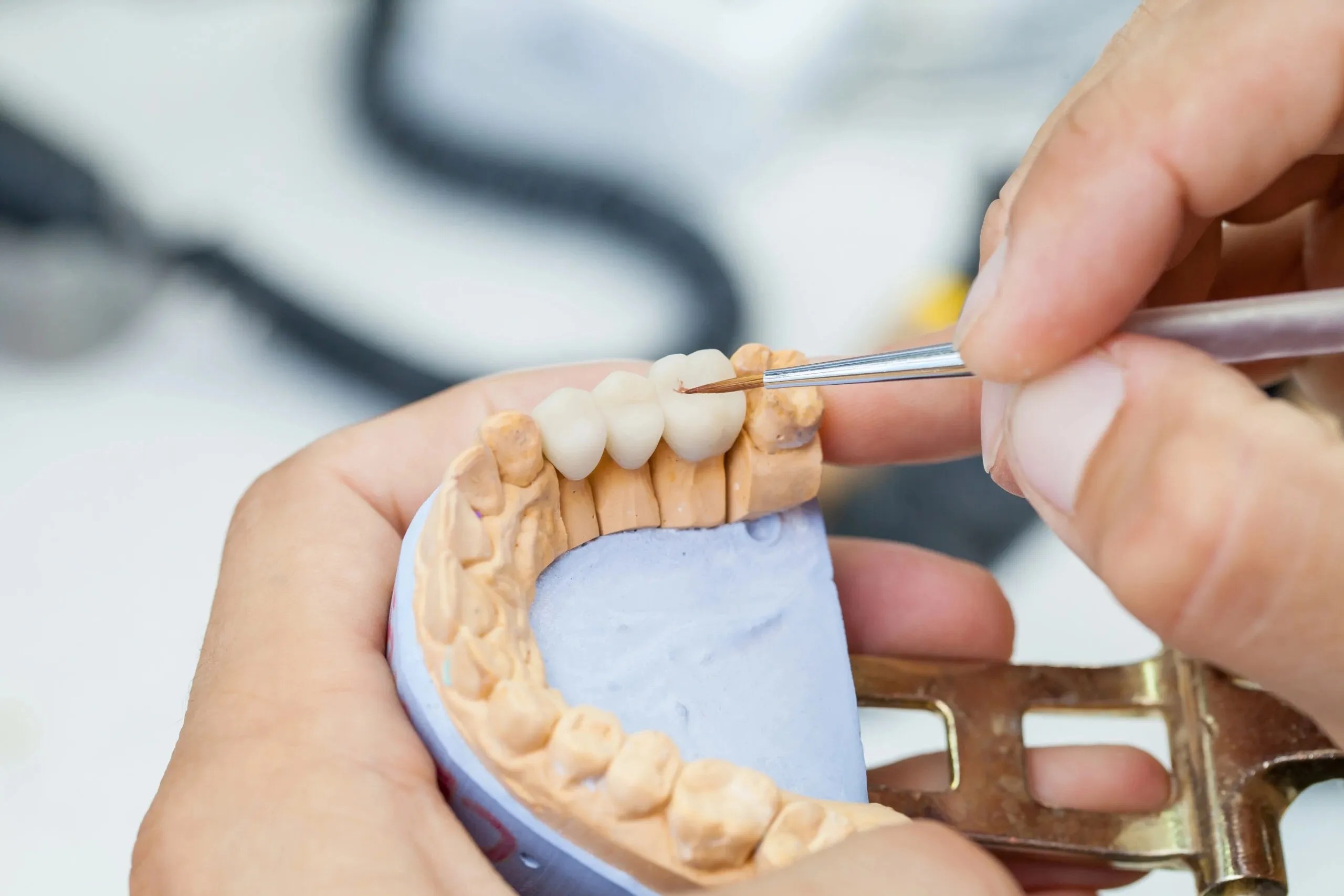Dental bridges at Crown Dental Group