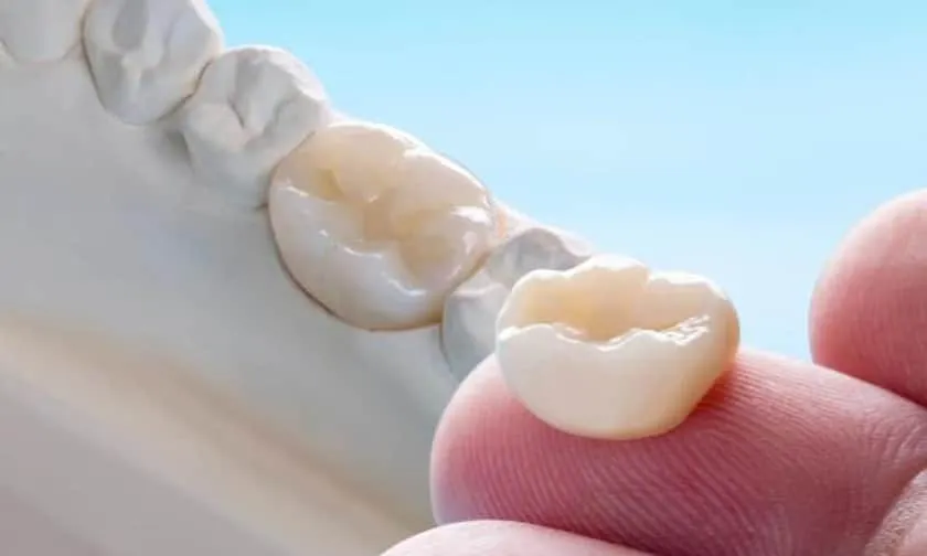 Dental crowns and caps at Crown Dental Group
