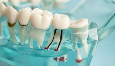 The Definitive Clinical Guide to Root Canal Therapy & Endodontics in National City, CA: Biological Mechanics, Pain Relief, and Tooth Preservation