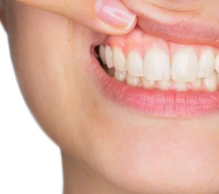 Explicación de la enfermedad de las encías