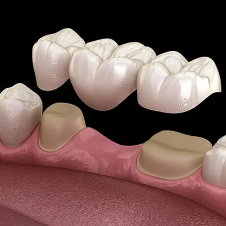 Impact of missing teeth