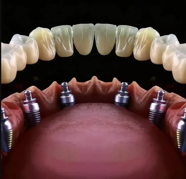 All-on-6 implant system