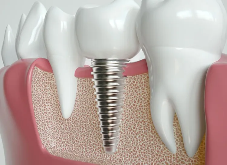Same day implant procedure