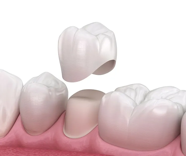 Dental crown preparation