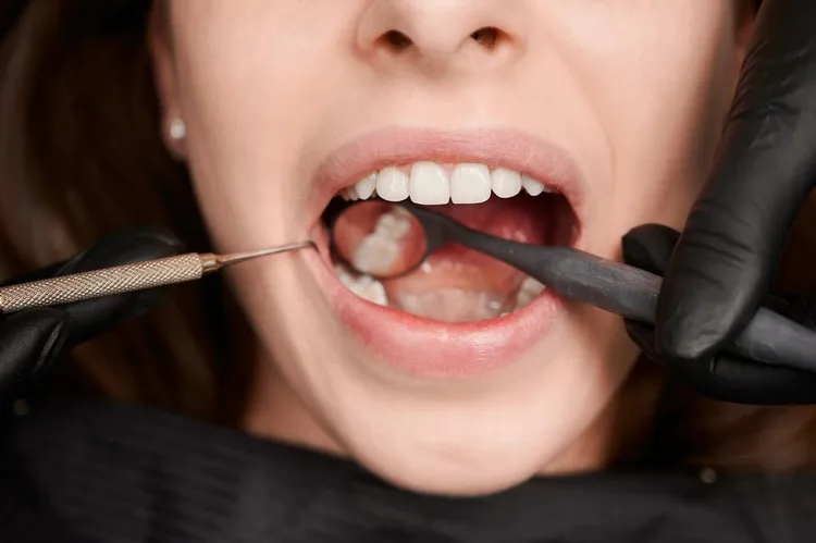 Dental filling procedure