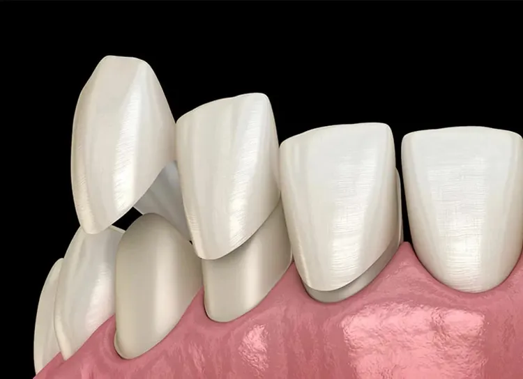 Dental veneers explained
