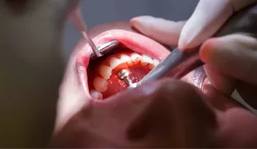 Why Your Gums Matter Just As Much As Your Teeth