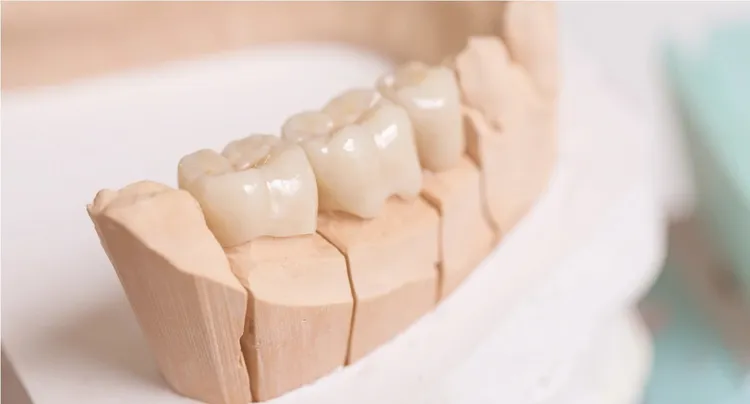 Dental bridge illustration