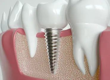 Missing Teeth and Jawbone Loss: What Every Patient Should Know
