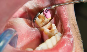 What Happens When You Ignore a Small Cavity? The Hidden Cost of Waiting