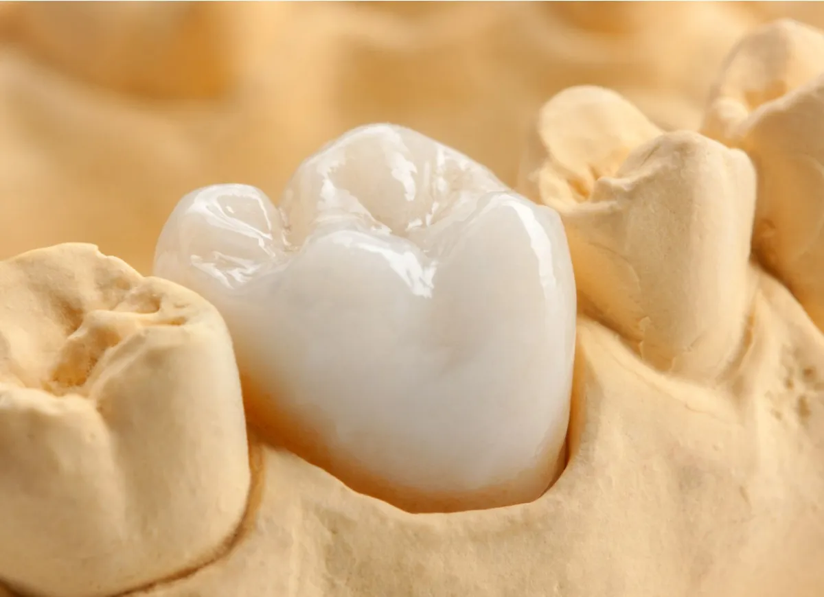 Ceramic Crowns Explained: The High-Tech Solution for Damaged Teeth in National City, CA