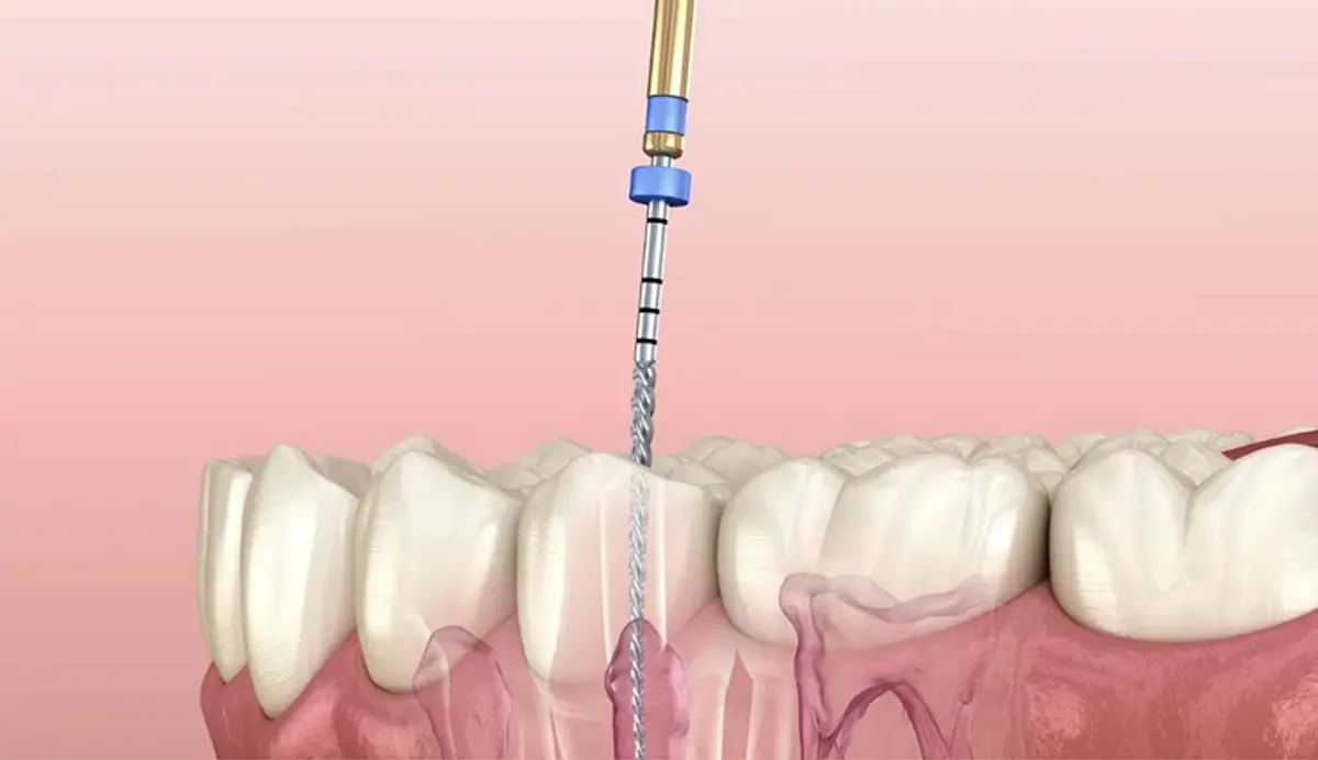 Understanding Root Canal Therapy: Saving Teeth Instead of Removing Them