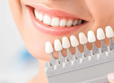 Porcelain Veneers in National City, CA: Your Solution for a Flawless Smile