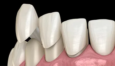 The Art of the Smile: Porcelain Veneers vs. Ceramic Crowns
