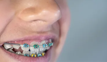Orthodontics for All Ages: It's Never Too Late for a Straight Smile