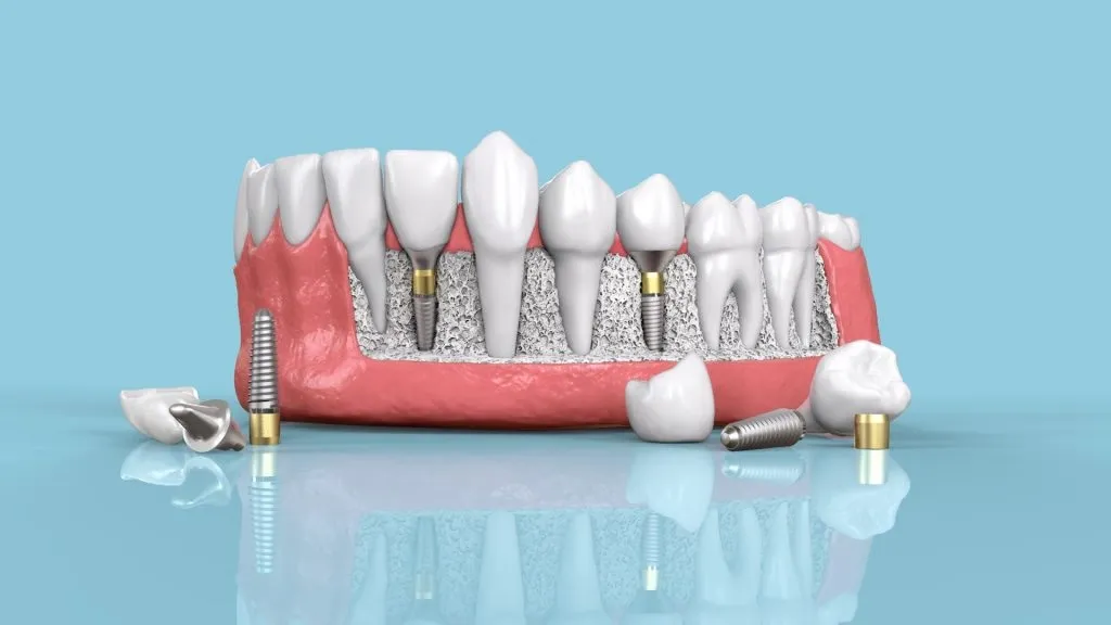 Crown Dental Blog