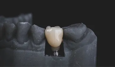 The Restorative Blueprint: Rebuilding Strength with Ceramics and Implants
