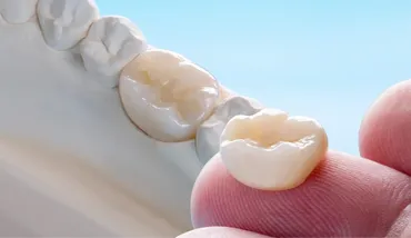 When a "Simple" Filling Isn't Enough: The Role of Ceramic Crowns & Caps