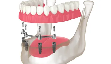 Full-Arch Restoration: The Difference Between All-on-4 and All-on-6 Implants