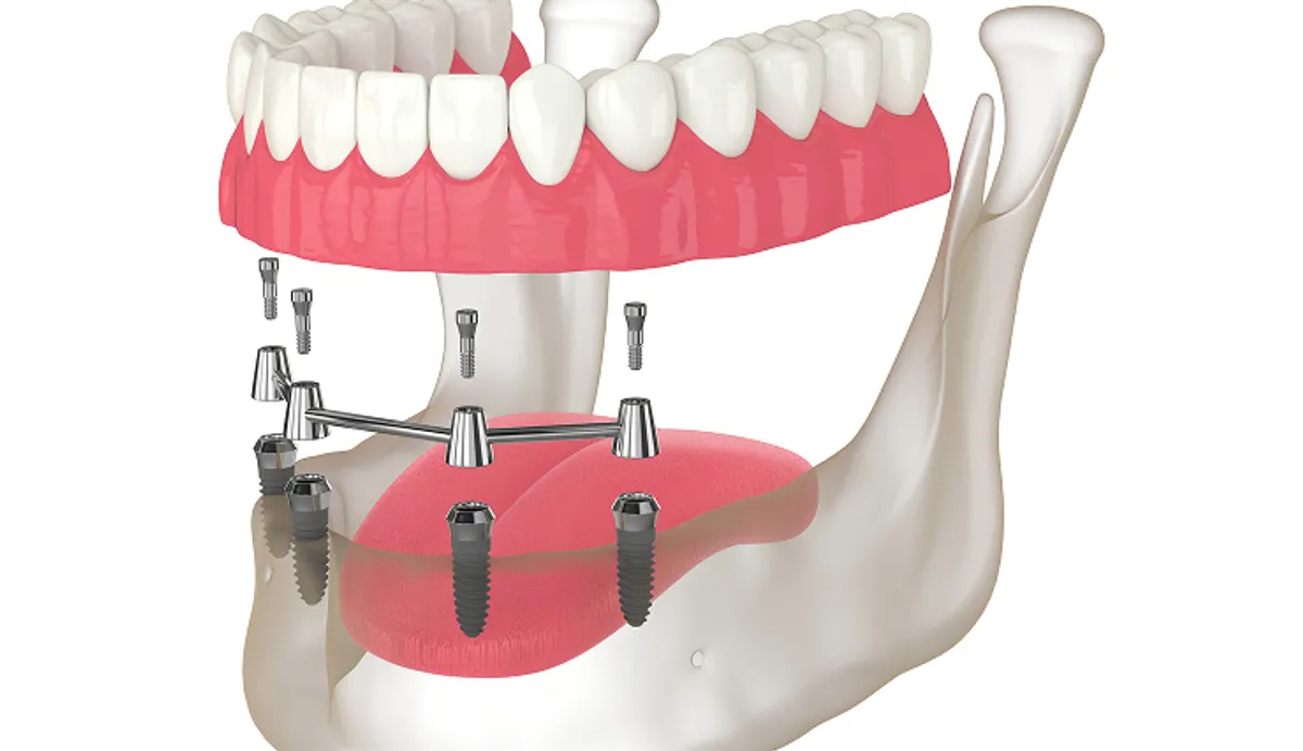 Full-Arch Restoration: The Difference Between All-on-4 and All-on-6 Implants
