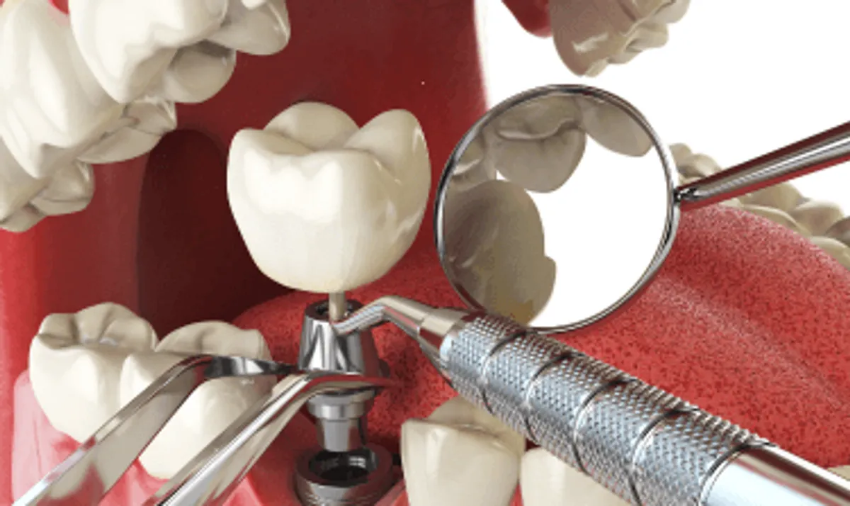 How Long Do Dental Implants Last? Maintenance Tips from Your National City Dentist