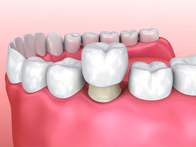 Crown Dental Group | Dentures, Same Day Implants and Night Guards